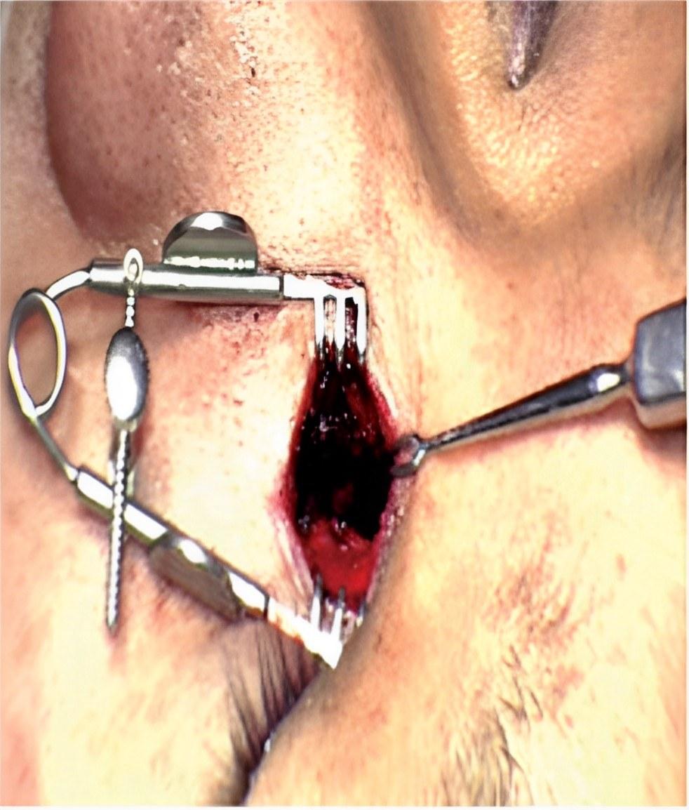 VOMS-400 4K 3D Operating Microscope (Ophthalmology) by JY Sometech — image 6